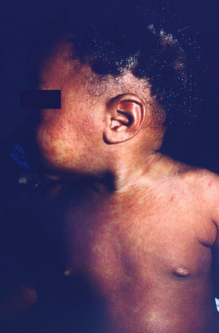 Pennsylvania’s Measles Outbreak Nears 1,000 Cases as the State and CDC Disagree on the Death Toll